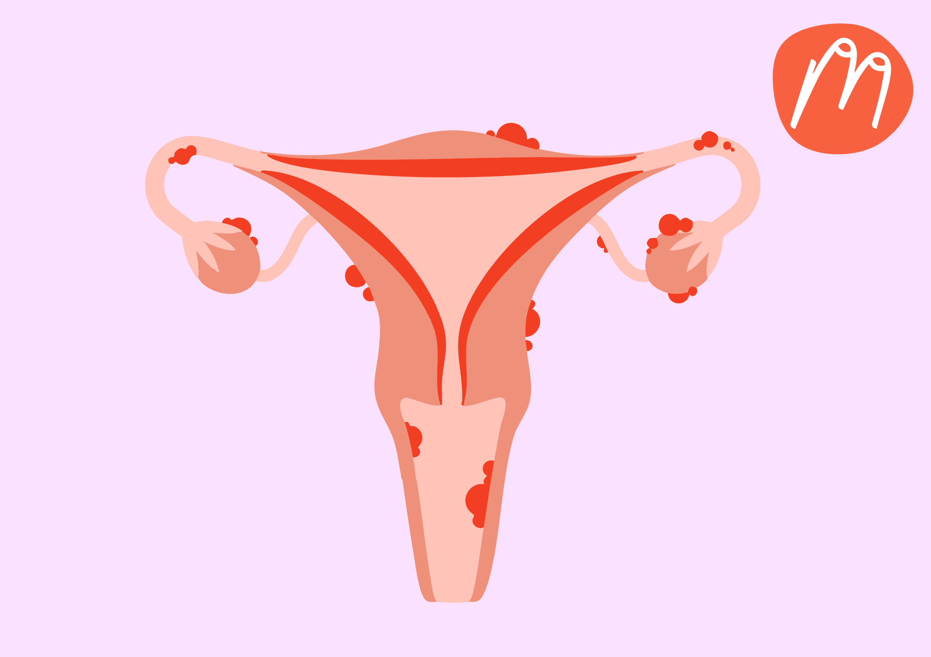 Was ist eine Endometriose? Ein Gespräch mit Dr.med Michaela Fischbach