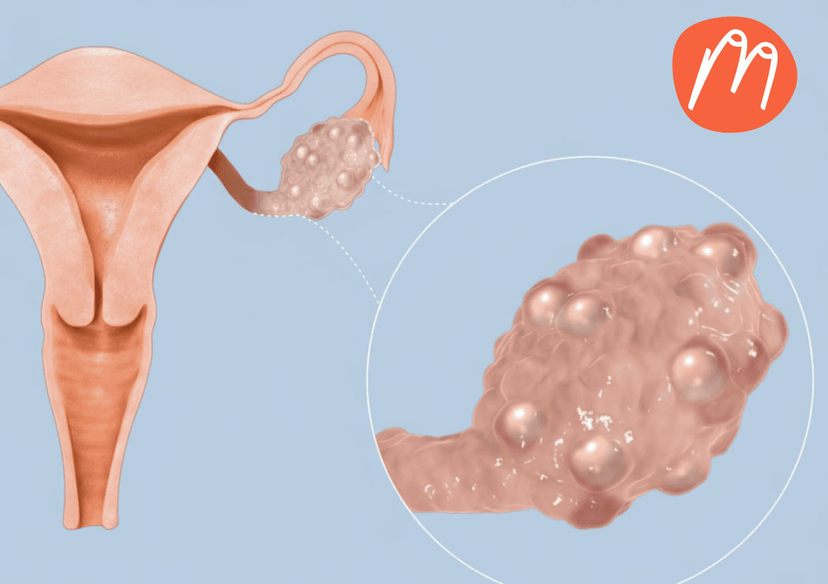 PCOS in the Summer: Why It Gets Harder—and How to Stay in Control